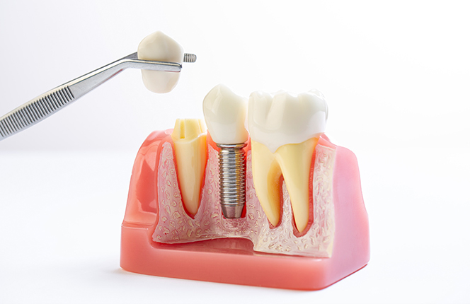 DENTIST|발치 후 즉시</br>임플란트